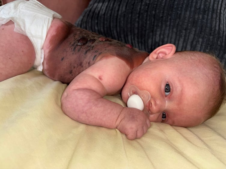 Macey-Mai was born with a Giant Congenital Melanocytic Nevus covering her back. Picture: Katelyn Clarke