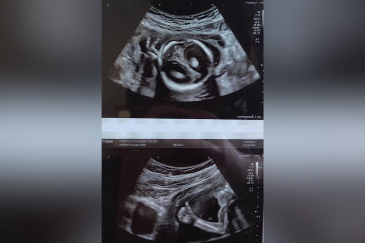 Miracle baby makes rude finger gesture at consultant then thumbs up.